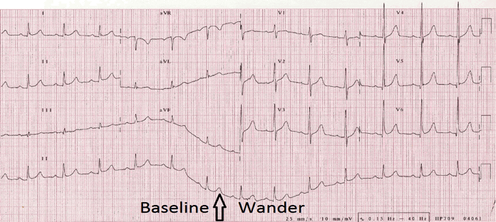 ECG Base Line Wander